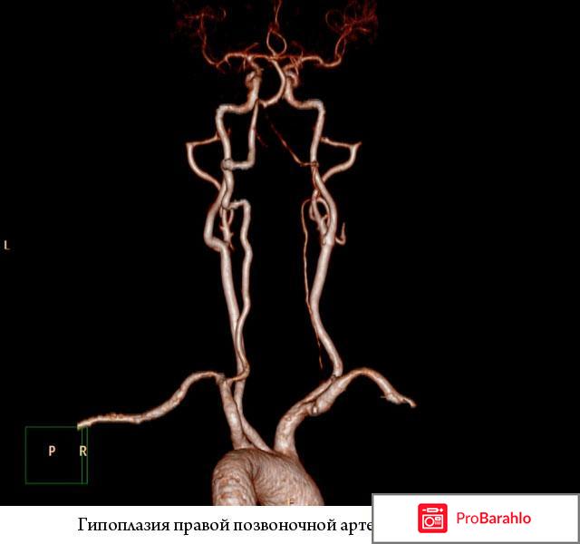 Лечение гипоплазии правой позвоночной артерии 2017 отрицательные отзывы