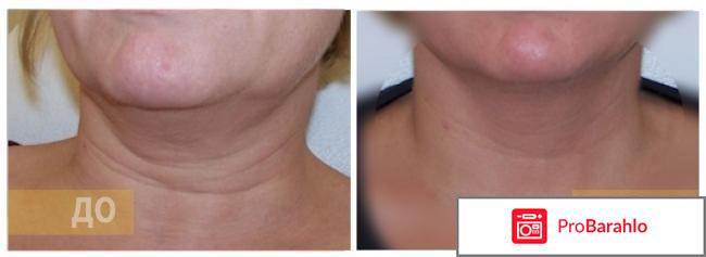 Липолитики для подбородка отрицательные отзывы