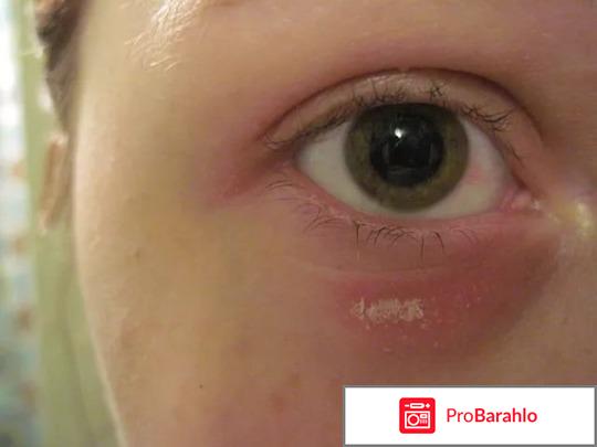 Болезнь Шегрена симптомы лечение обман