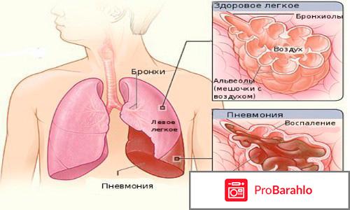 Воспаление легких 