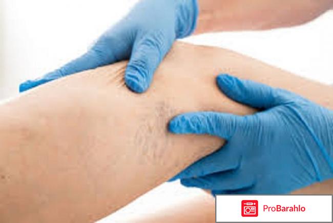 NANOVEN (Нановен) от варикоза отрицательные отзывы