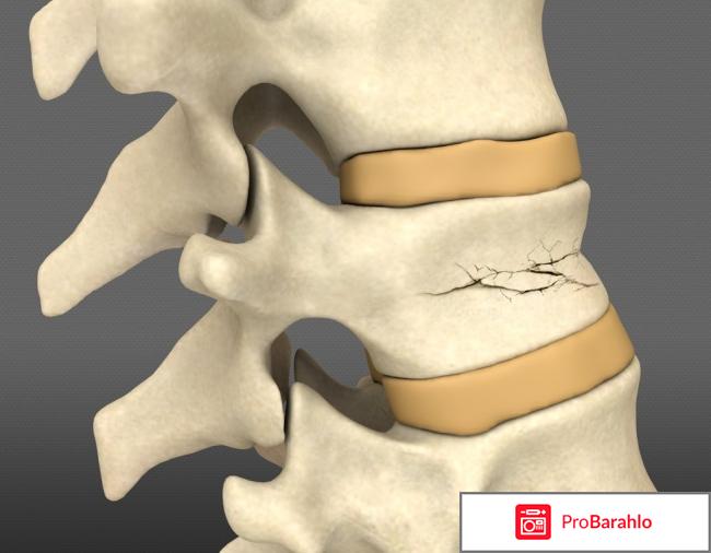 Ретролистез l2 позвонка что это такое обман