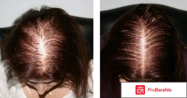 Пантовигар фото до и после у женщин отрицательные отзывы