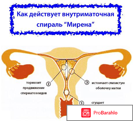 Гормональная спираль мирена отрицательные отзывы