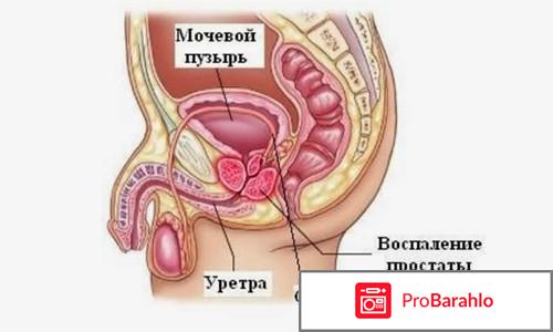 Лечение простатита народными средствами 