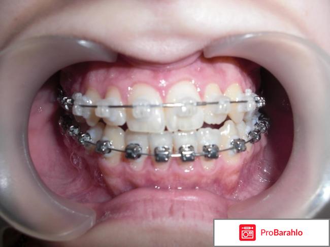 Брекеты дэймон 