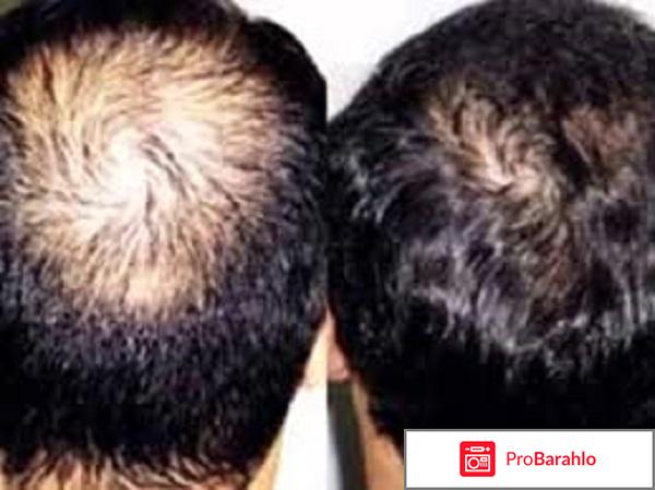 Ниоксин от выпадения волос отзывы 