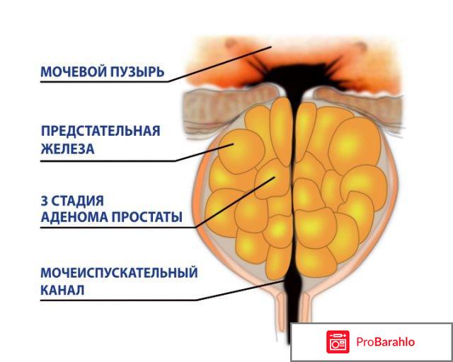 Аденома простаты у мужчин симптомы лечение отзывы обман