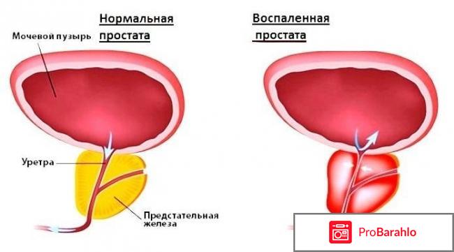 Средство против простатита 