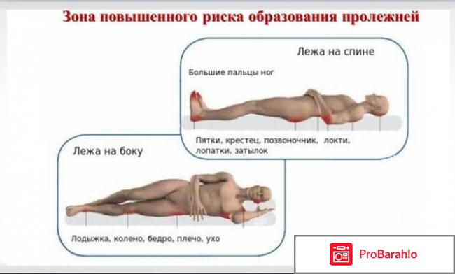 Пролежни: виды, симптомы, лечение, осложнения 