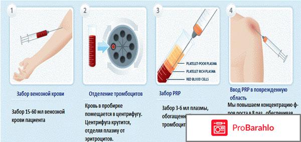 PRP терапия отзывы для лечения суставов отзывы владельцев