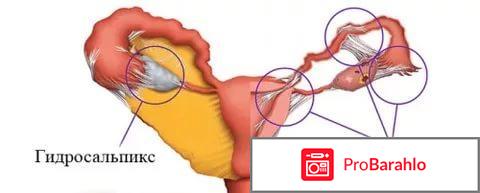 Маточные спайки отрицательные отзывы