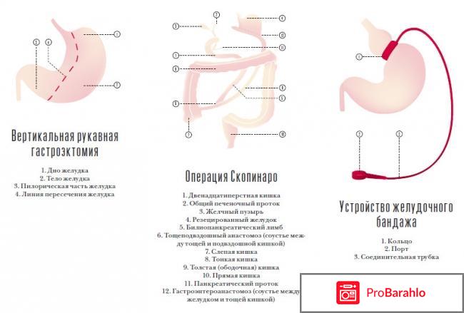 Как уменьшить объем желудка чтобы меньше есть отрицательные отзывы