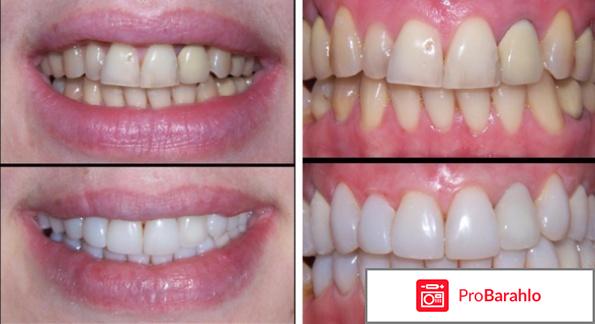 Терапевтические виниры 