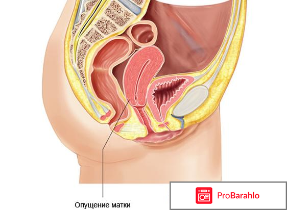 Опущение влагалища 