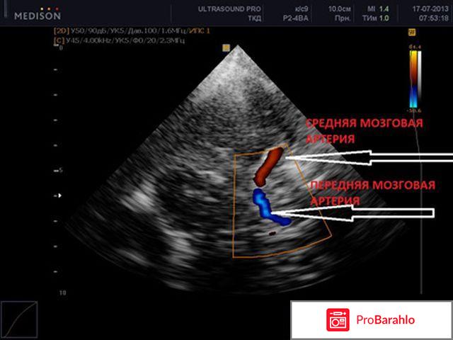 Узи брахиоцефальных сосудов головы и шеи отзывы владельцев