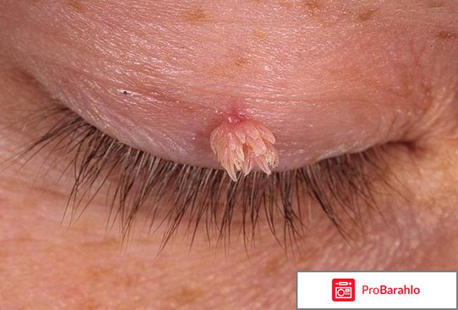 Папилайт средство от папиллом и бородавок 