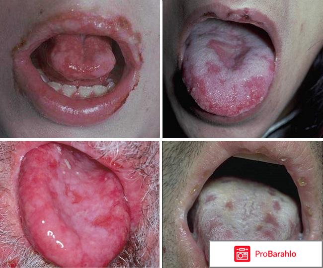 Пятна на языке у взрослых и детей, причины реальные отзывы