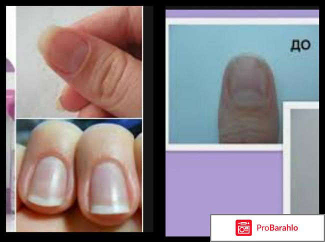 Кутикула на ногтях: обзор средств и способов удаления 