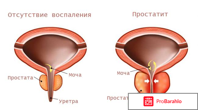 Медовый сбитень от простатита купить отрицательные отзывы