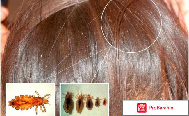 Шампунь от вшей отзывы обман