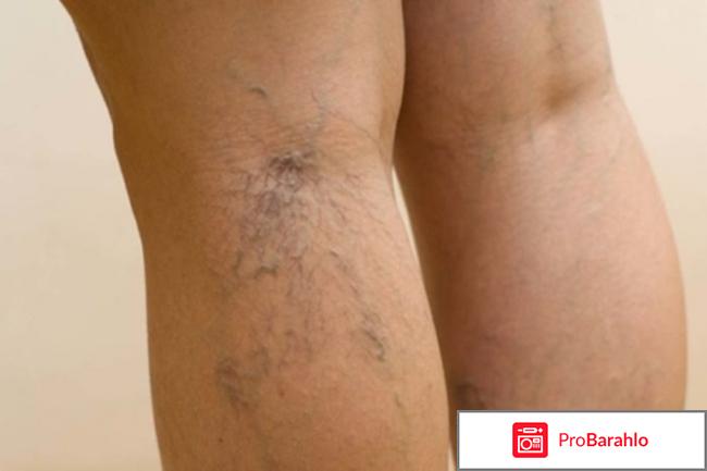 Варикозон - средство от варикоза обман