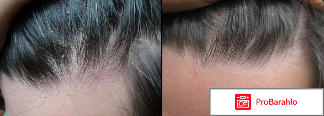 Циновит шампунь обман