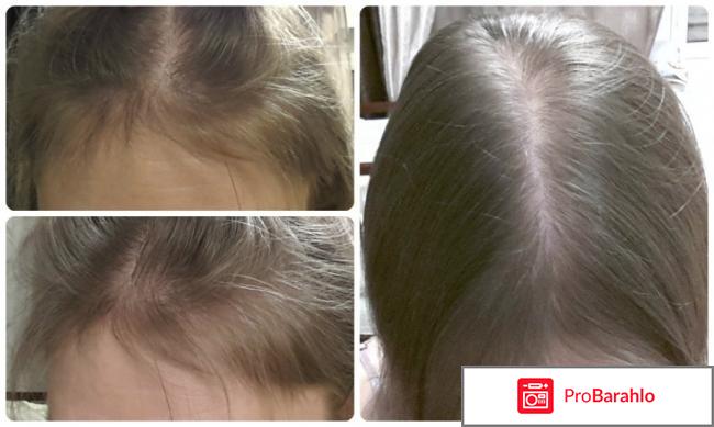 Дарсонваль для волос отзывы отрицательные отзывы