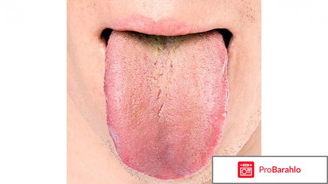 Язык шершавый: причины отрицательные отзывы