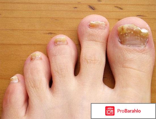 Экзодерил от грибка обман