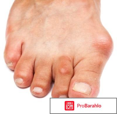 Hallux valgus отзывы отрицательные отзывы