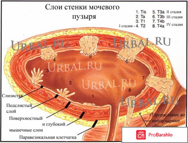 Тур мочевого пузыря отзывы отрицательные отзывы