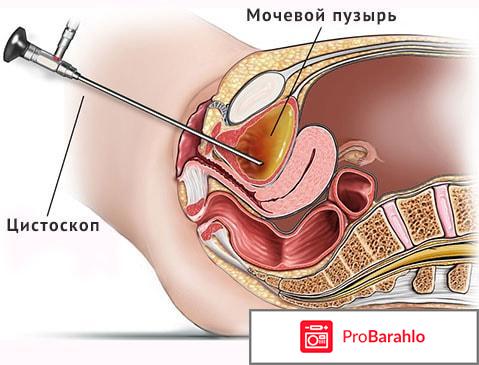 Цистоскопия отзывы отрицательные отзывы