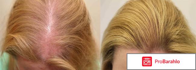 Регейн для волос отзывы женщин отрицательные отзывы