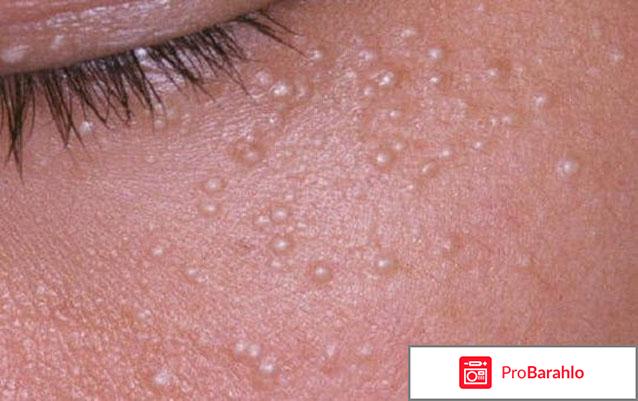 Жировики под глазами: почему они возникают отрицательные отзывы