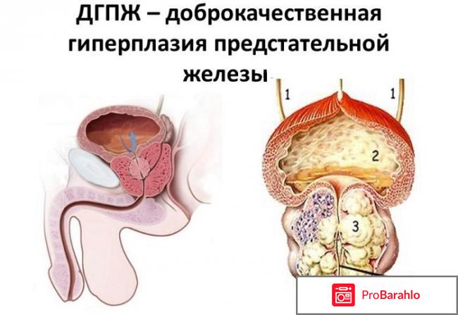 Доксазозин инструкция по применению цена отзывы врачей 