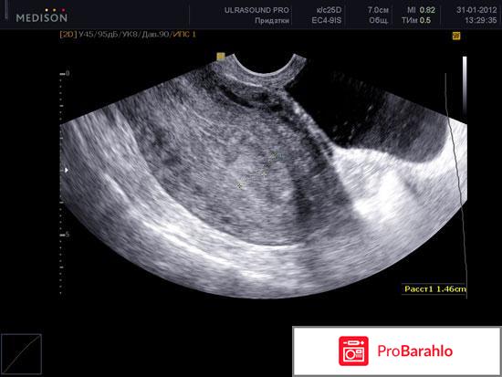 Как подготовиться к узи матки и придатков отрицательные отзывы