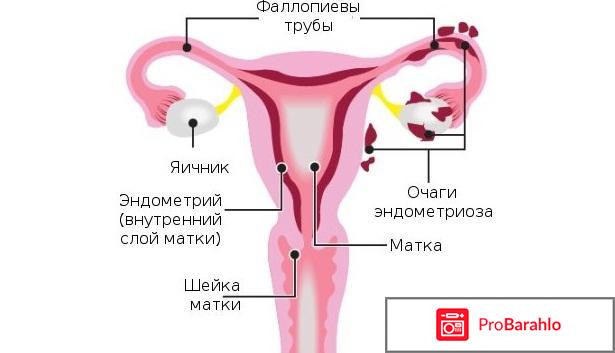 Эндометриоз матки лечение 