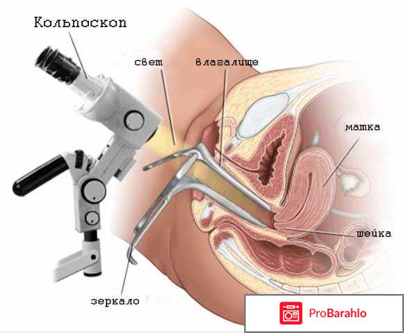 Кольпоскопия шейки матки отрицательные отзывы