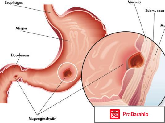 Как отличить гастрит с повышенной и пониженной кислотностью отрицательные отзывы