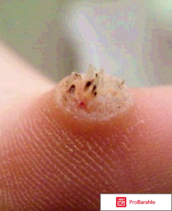 Крем-паста для устранения подошвенных бородавок Фармтек Вартокс 