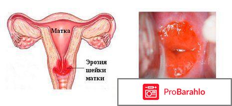 Сургитрон лечение эрозии шейки матки отзывы обман