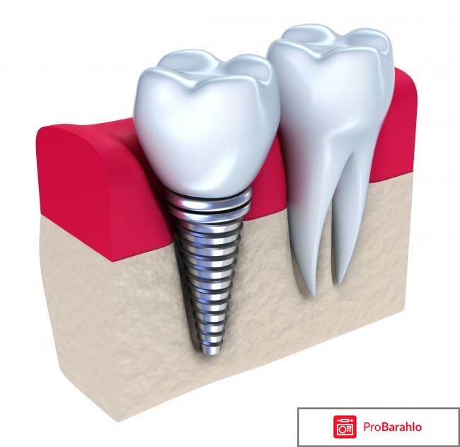 Имплантирование зубов 