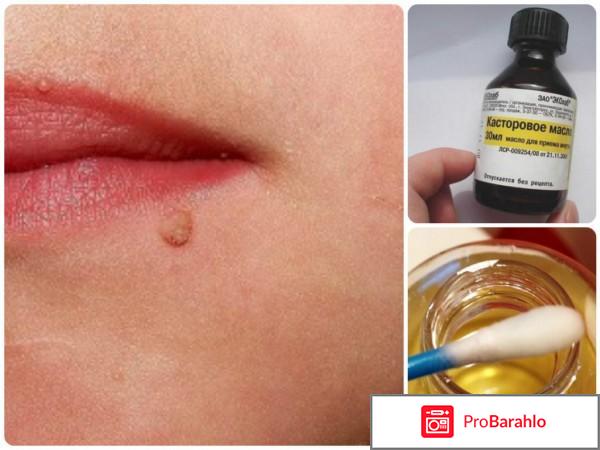 Лечение папиллом касторовым маслом отрицательные отзывы