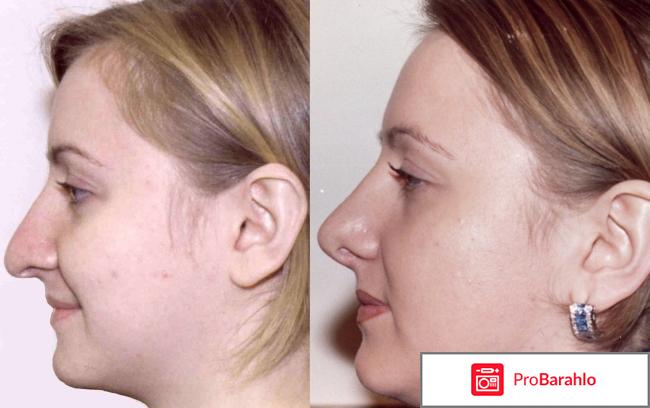 Ринопластика носа обман