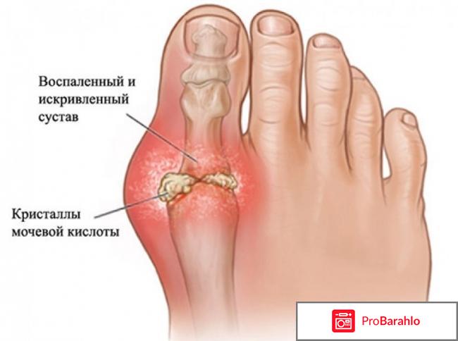 Как избавиться от мочевой кислоты отрицательные отзывы