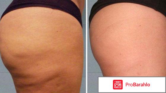 Вакуумный массаж отзывы фото реальные отзывы