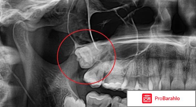 Удаление ретинированного зуба мудрости отрицательные отзывы