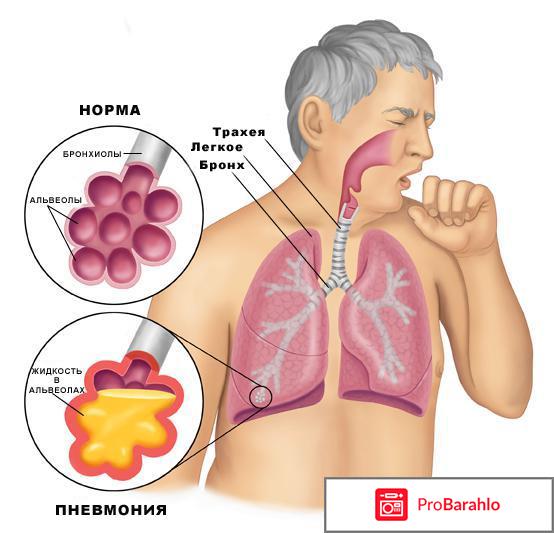 Воспаление лёгких симптомы 