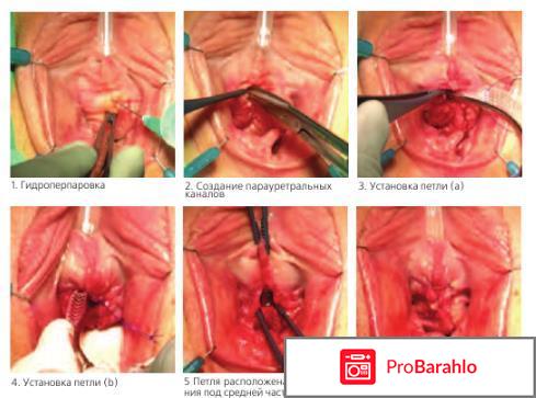 Операция по недержанию мочи у женщин отзывы обман